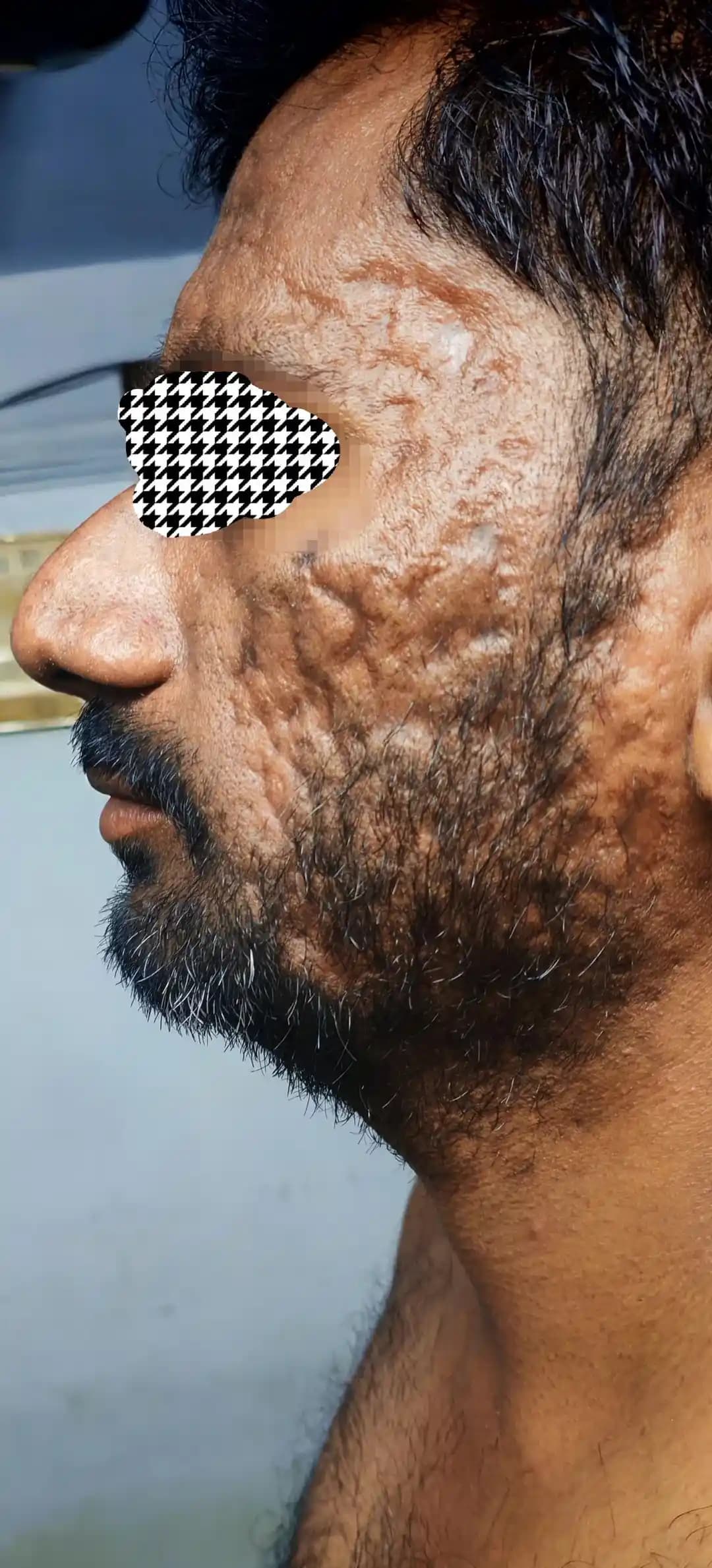 30 Yaşında Akne İzleri: Etkili Tedavi Yöntemleri ve Uzman Yaklaşımları