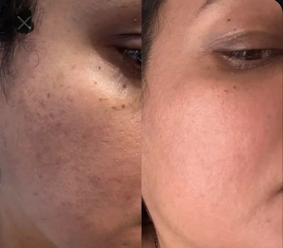 40 Yaş Sonrası Cilt Bakımında Lazer ve Ürünlerle 6 Aylık İyileşme Yöntemleri