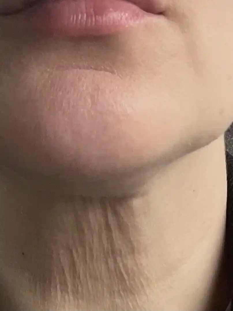 40 Yaş ve Üzeri Boyundaki Tavuk Derisi Görünümünün Nedenleri ve Bakım Yöntemleri