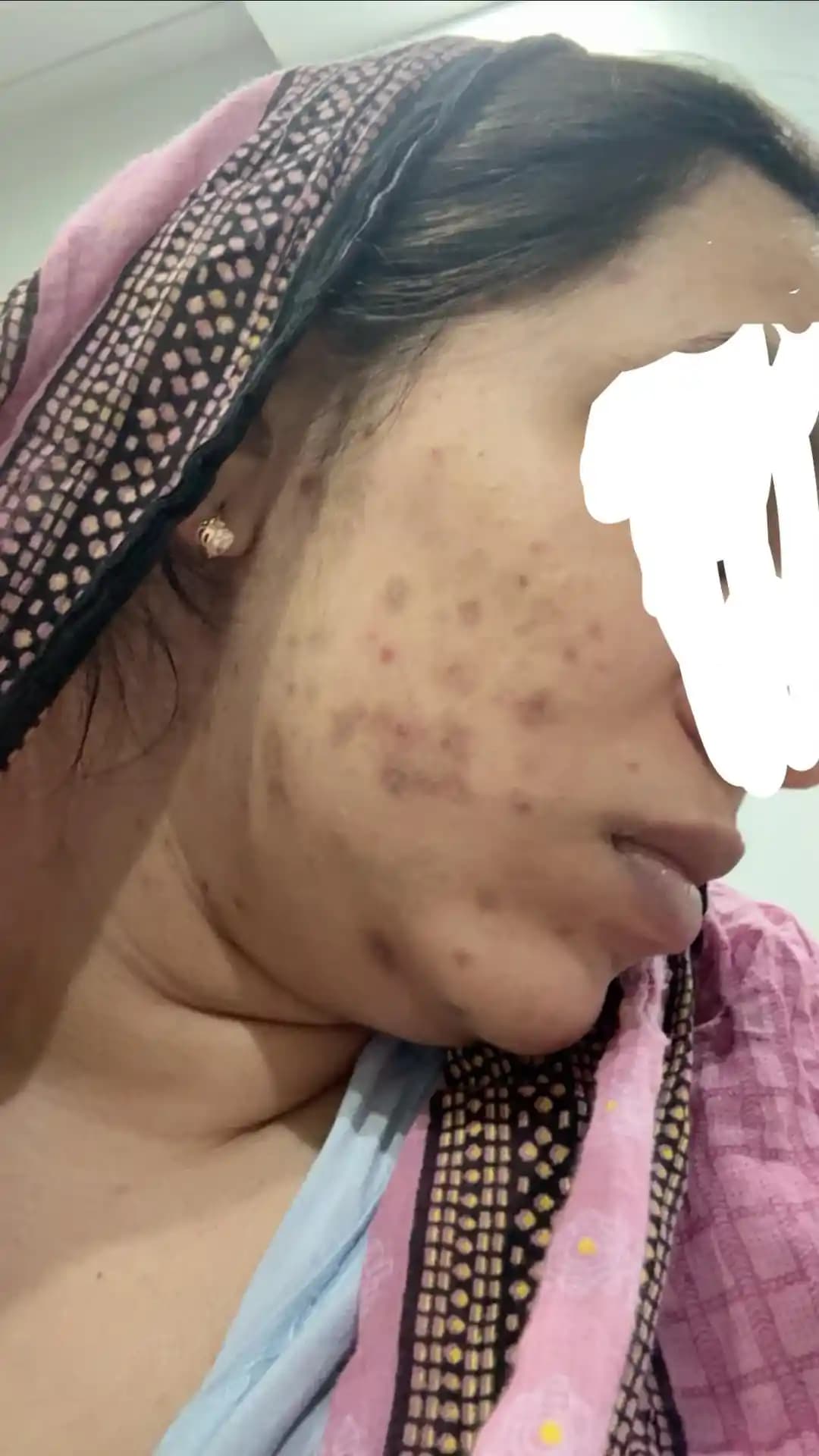 Ani ve Şiddetli Akne Problemlerinin Nedenleri ve Etkili Tedavi Yöntemleri