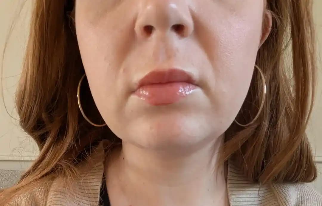 Çene ve Çift Çene Estetiğinde Botox ve Alternatif Kalıcı Yöntemlerin Değerlendirilmesi