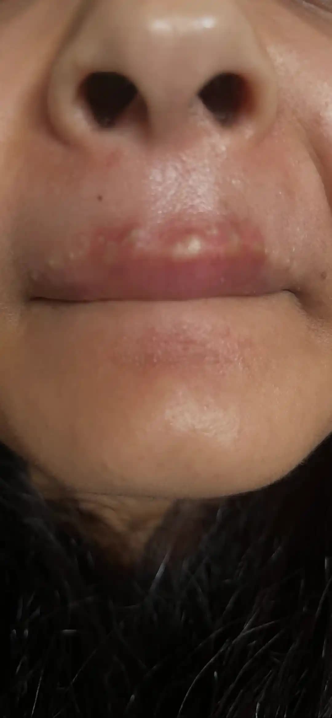 Dudak Çevresinde Tıkanmış Gözenekler ve Kapalı Komedonların Nedenleri ve Tedavi Yöntemleri