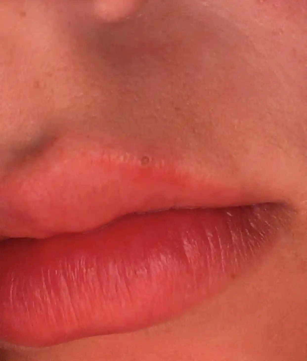 Dudak Kenarındaki Siyah Noktalar: Müdahale Yöntemleri ve Risk Değerlendirmesi