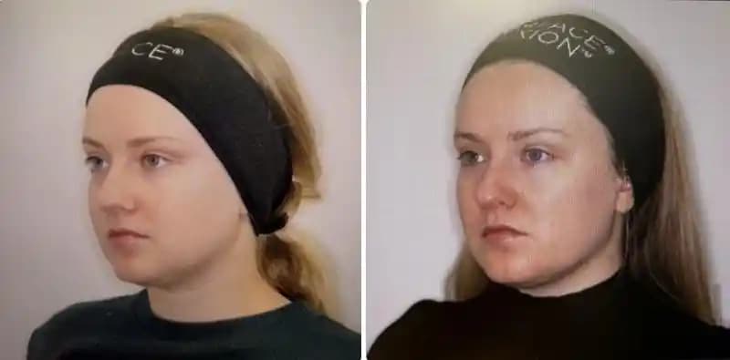 Emface Tedavisinin Yüzdeki Etkileri, Riskleri ve Dikkat Edilmesi Gereken Hususlar