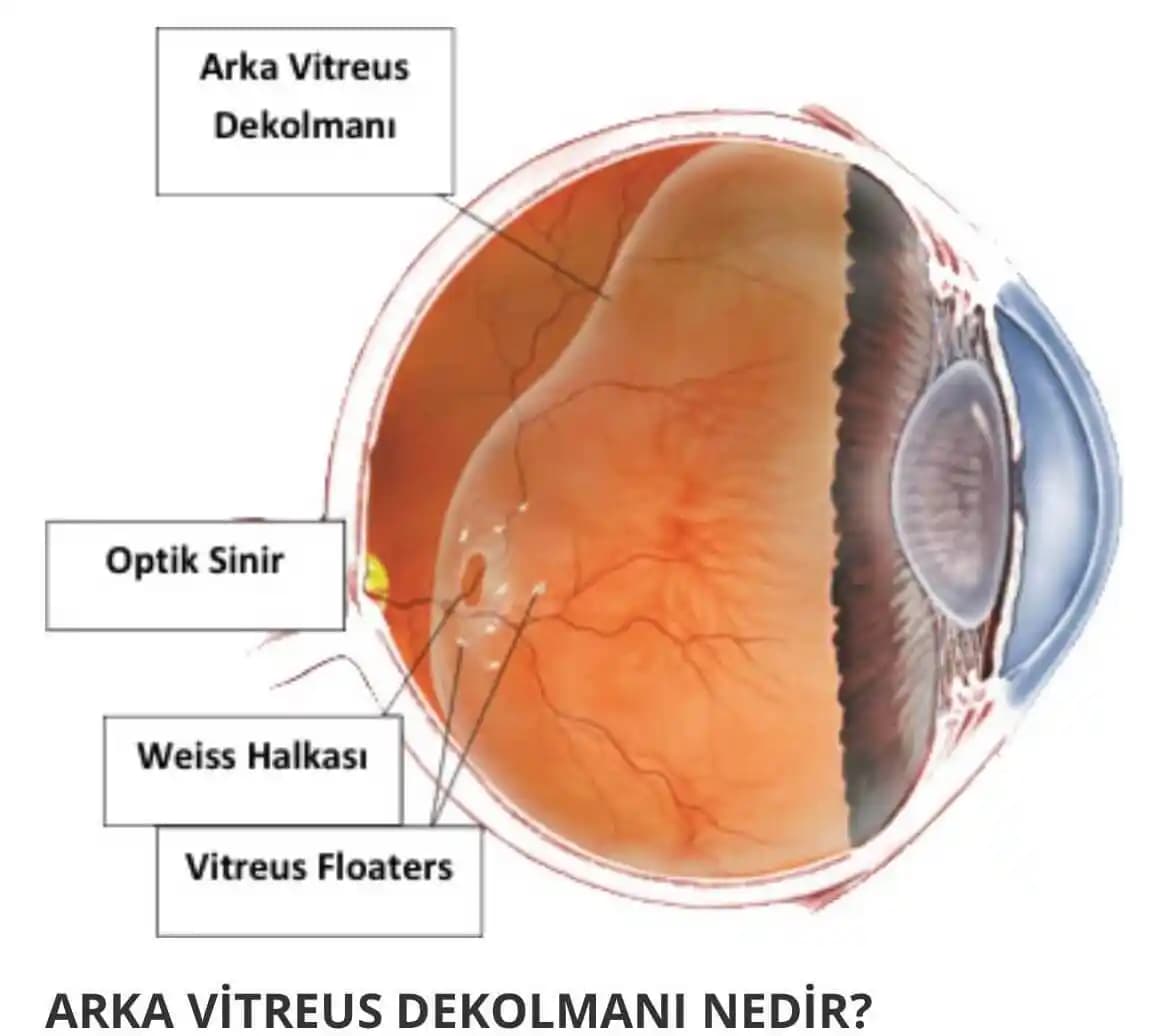 Göz Farında Yabancı Cisimler: Nedenleri, Riskleri ve Güvenlik Önlemleri