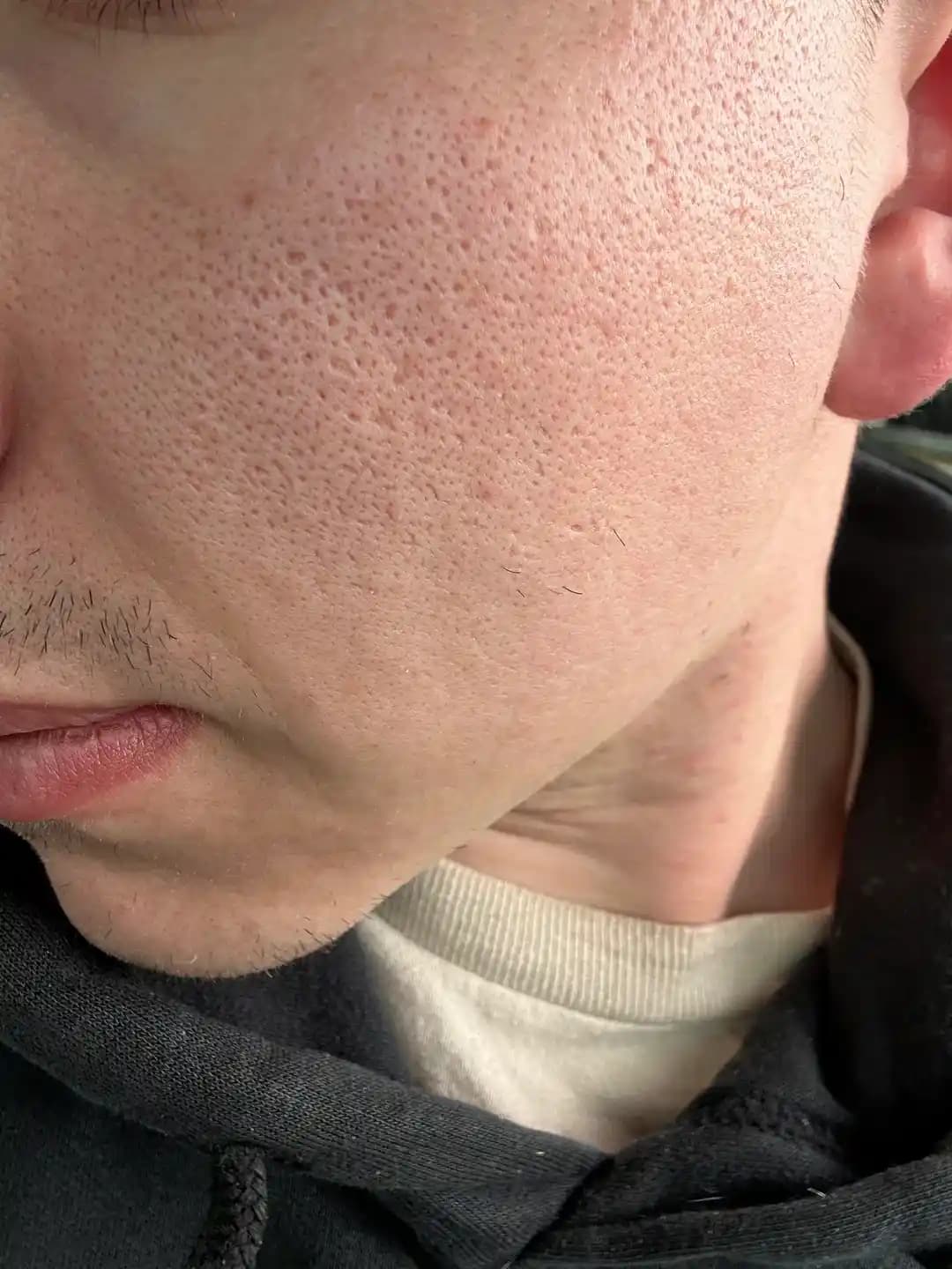 Gözenek Onarımı ve Akne İzleri İçin Etkili Dermatolojik Yöntemler ve Bakım Önerileri