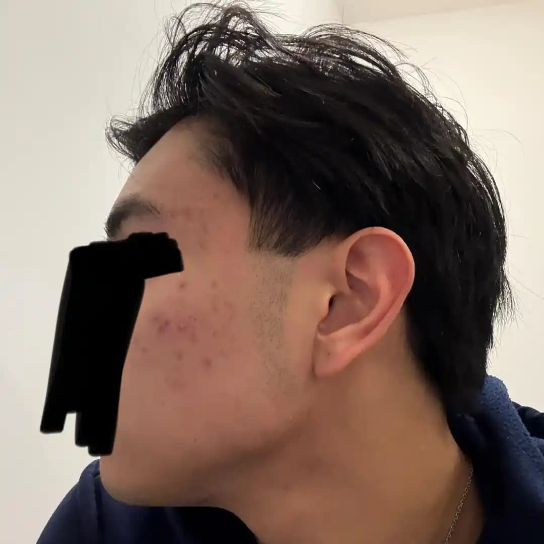 Hormonal Akne Tedavisinde 1 Yıllık Değişim ve Etkili Cilt Bakım Rutini Önerileri