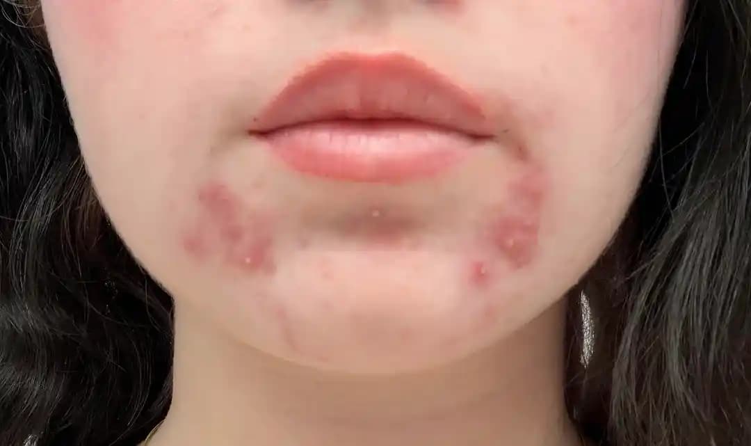 Perioral Dermatit ve Hormonal Akne: Nedenleri, Tedavisi ve Cilt Bakımı Önerileri