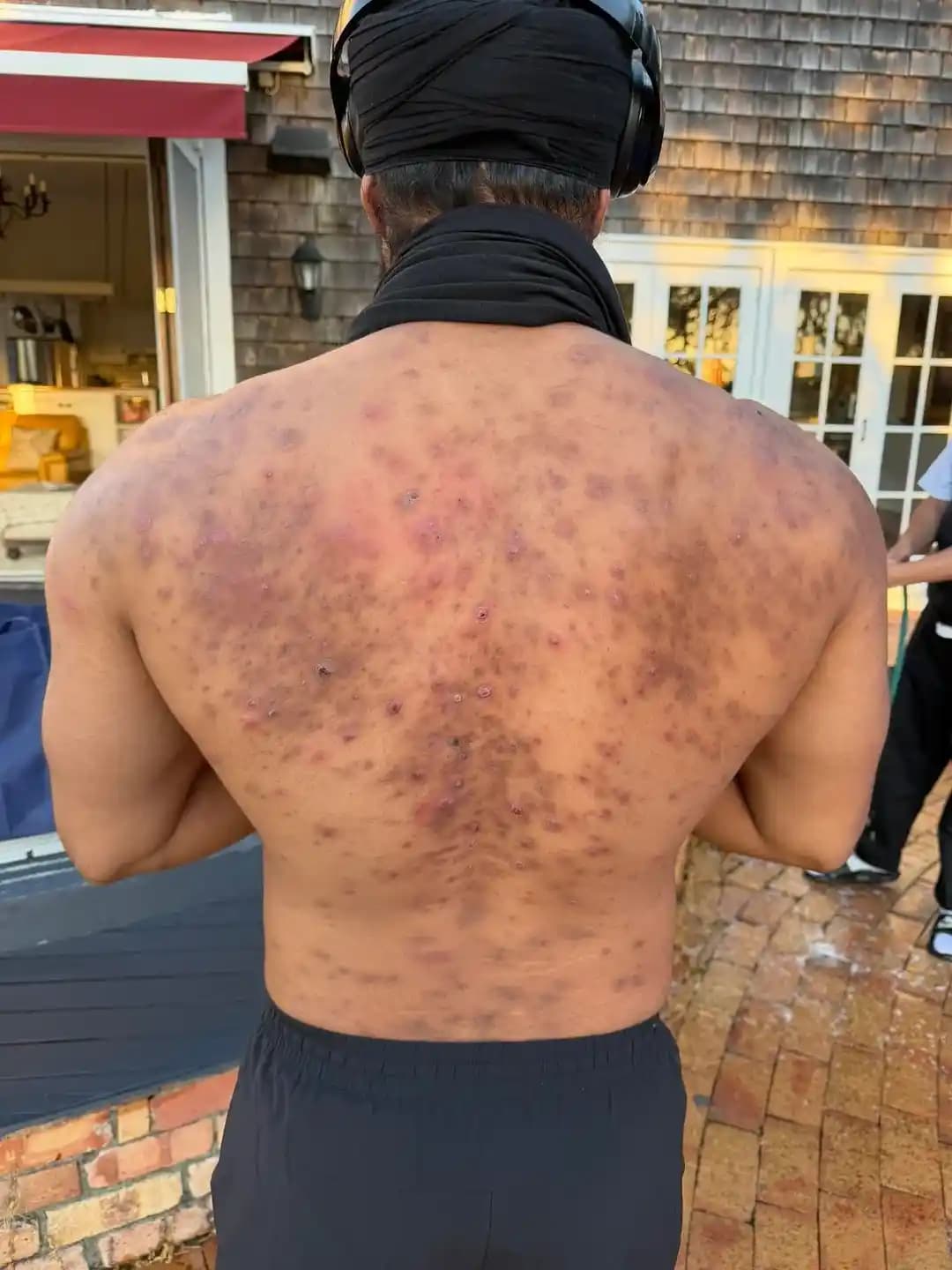 Şiddetli Sırt Aknesi: Nedenleri, Tedavi Yöntemleri ve Dozajın Önemi Üzerine Detaylı İnceleme