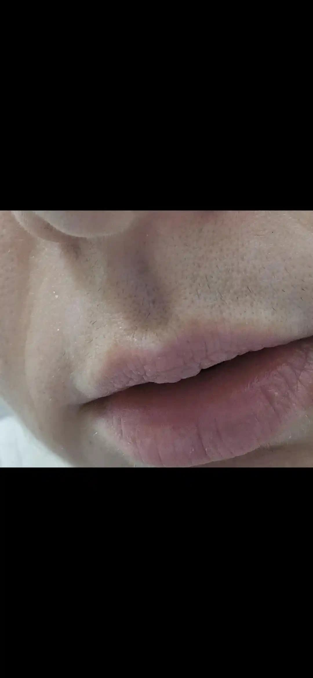 Yüz Kılları ve Tüy Problemlerinde Lazer, Elektrolysis ve Alternatif Yöntemlerin İncelenmesi