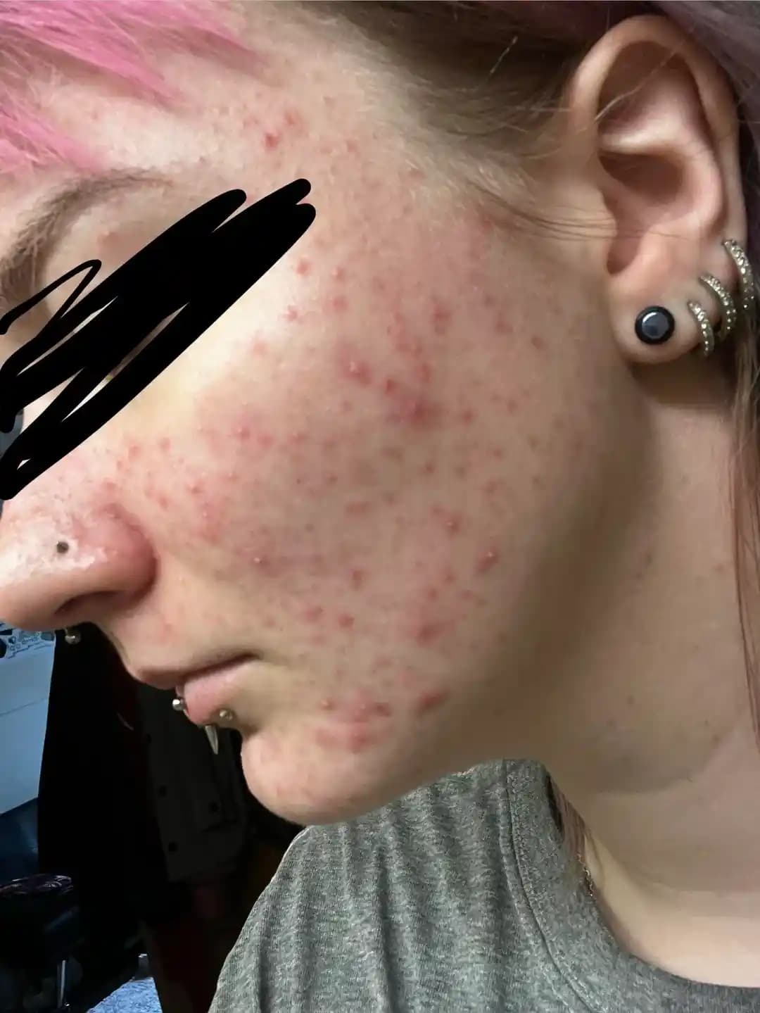 Akne Tedavisinde Doğru Cilt Bakımı ve Uzman Önerileri ile Etkili Sonuçlar