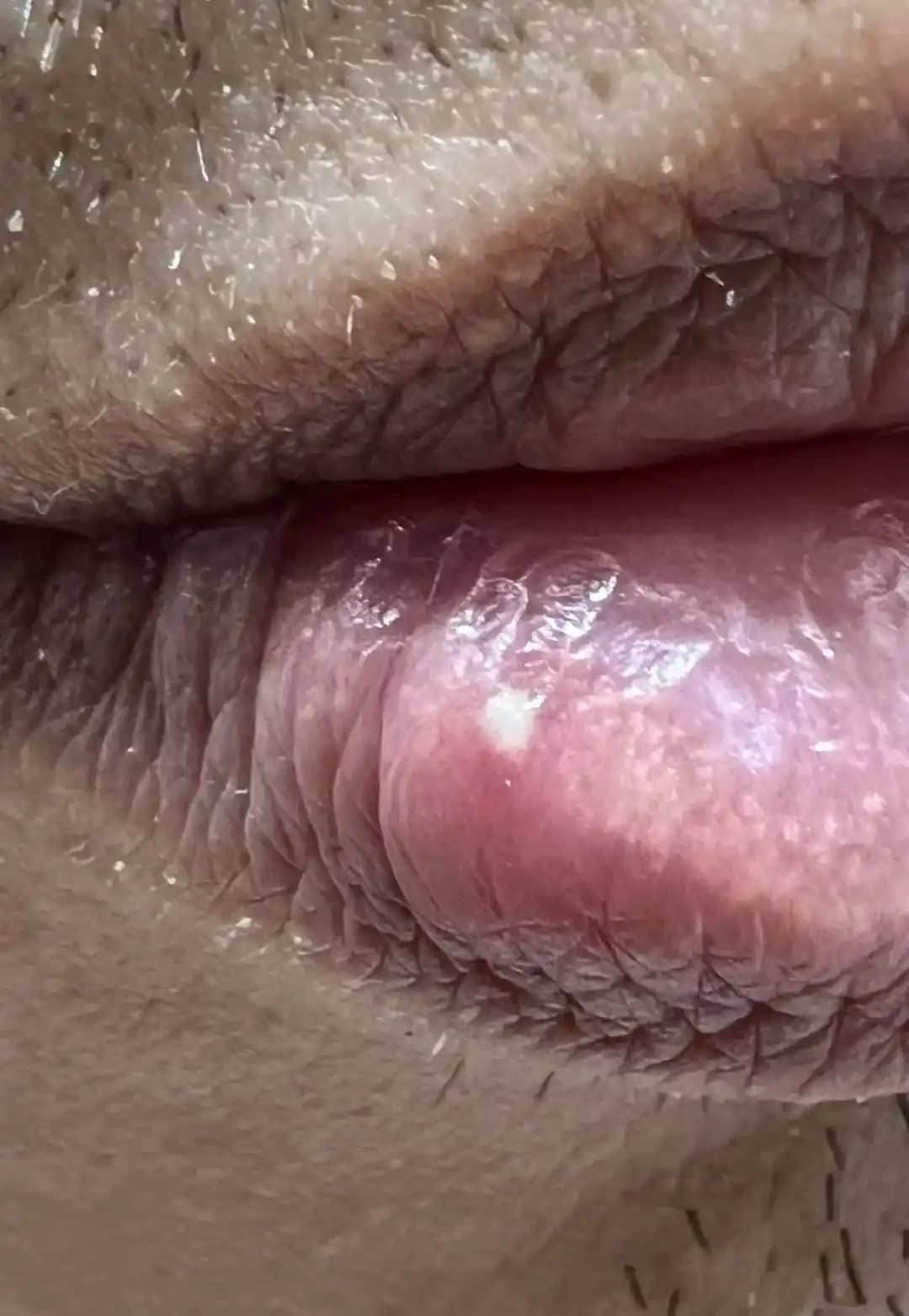 Dudakta Sivilce ve Lezyonların Nedenleri ile Etkili Tedavi Yöntemleri