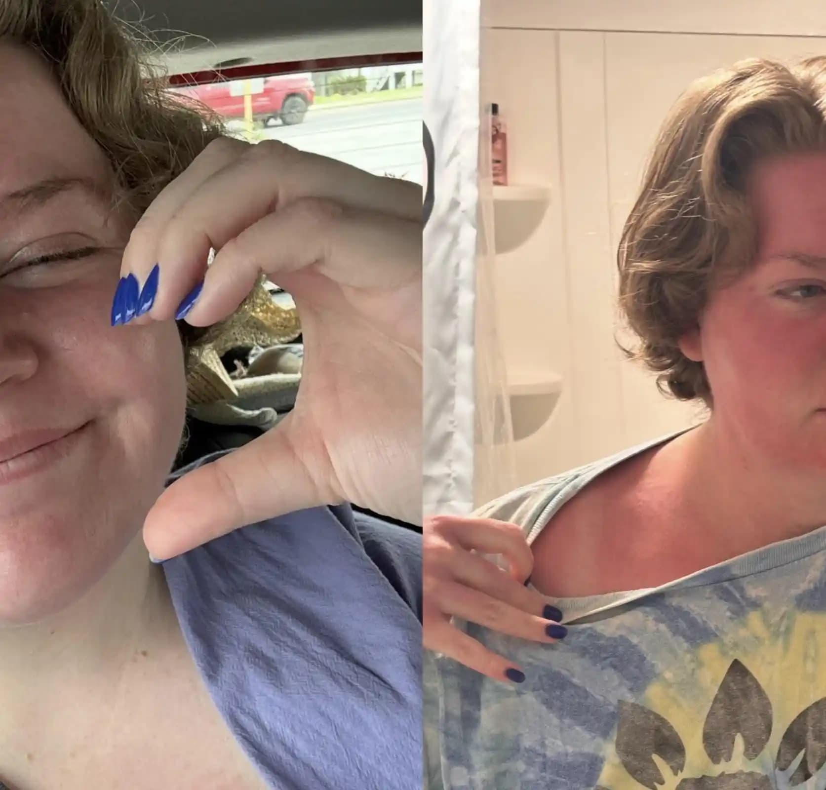 Güneş Koruyucu Seçimi ve Aşırı Güneş Hassasiyetinin Nedenleri ve Korunma Yöntemleri