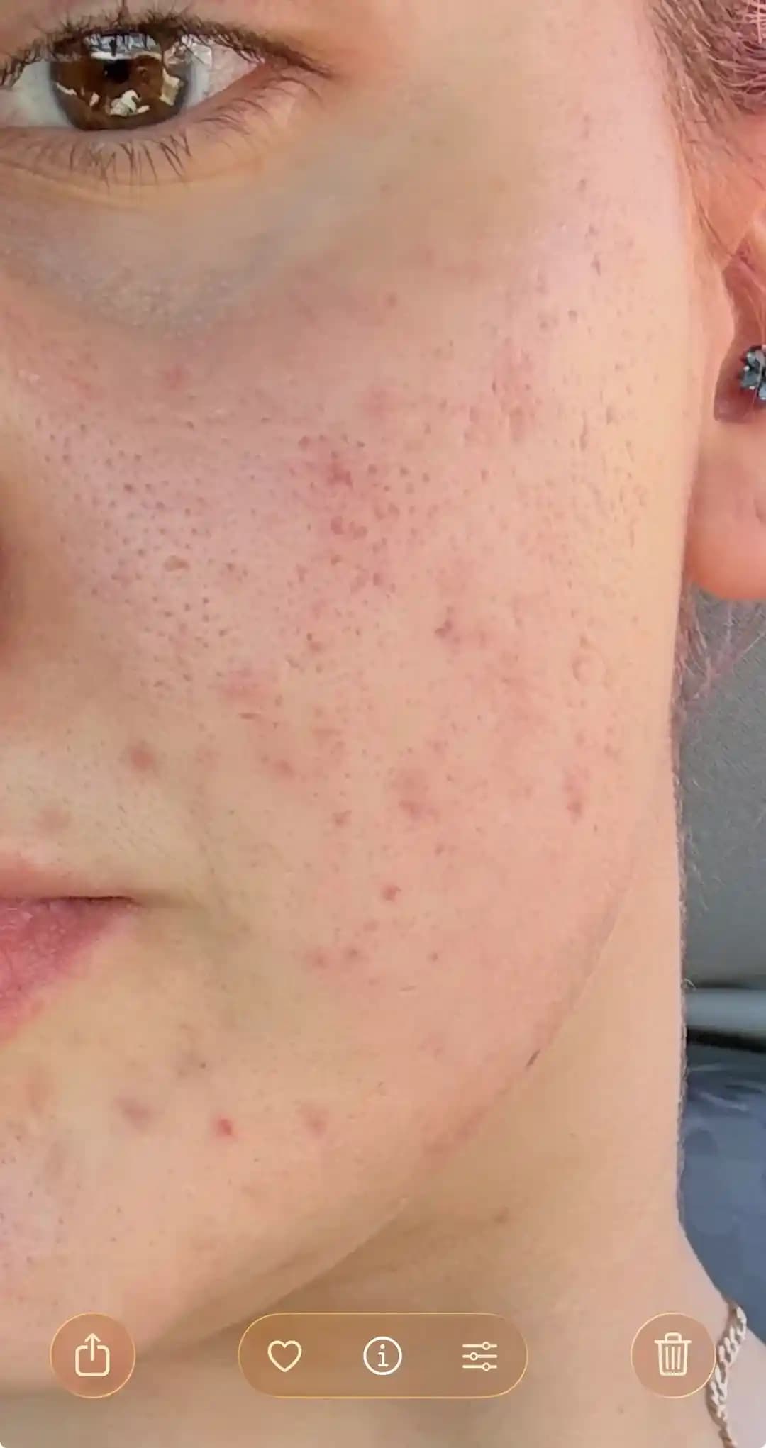 Hormonal Akne Tedavisinde Lazer Uygulamaları ve Azelaik Asit Kullanımının Rolü