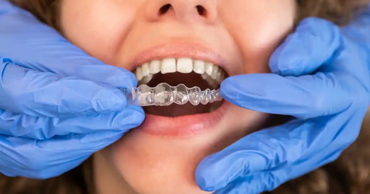 Invisalign Tedavisi Sonrası Yüzdeki Değişiklikler ve Jowls Ayrımı Üzerine Analiz