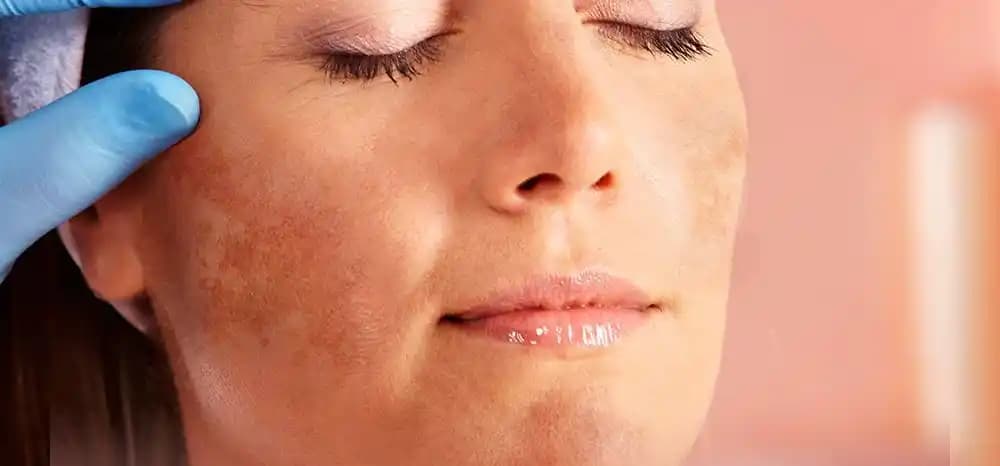 Melazma ve Hiperpigmentasyon: Nedenleri, Korunma Yöntemleri ve Tedavi Seçenekleri