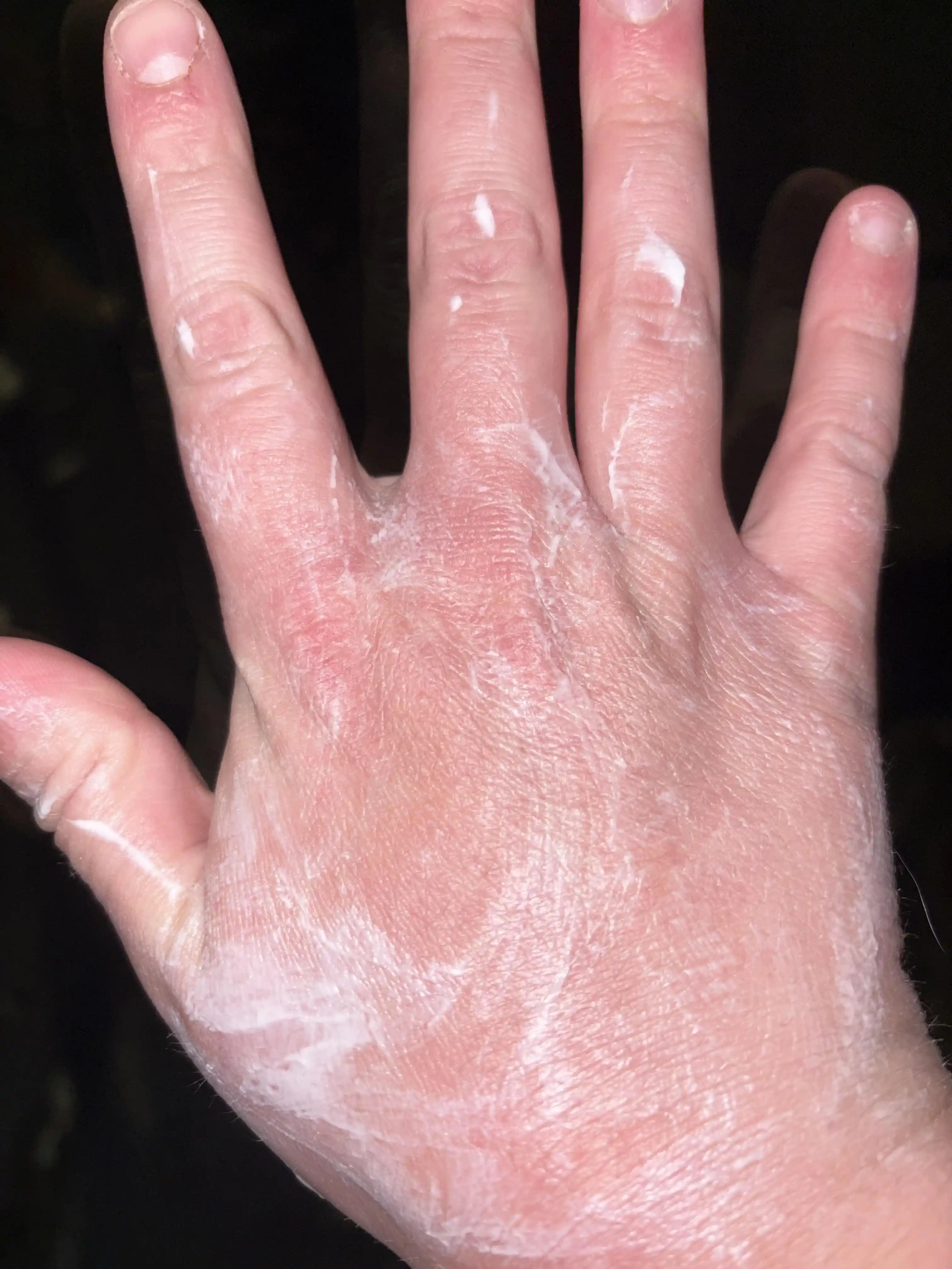 O’Keeffe’s Working Hands Kremi Kullanımı ve Eczema İçin Alternatif Nemlendiriciler