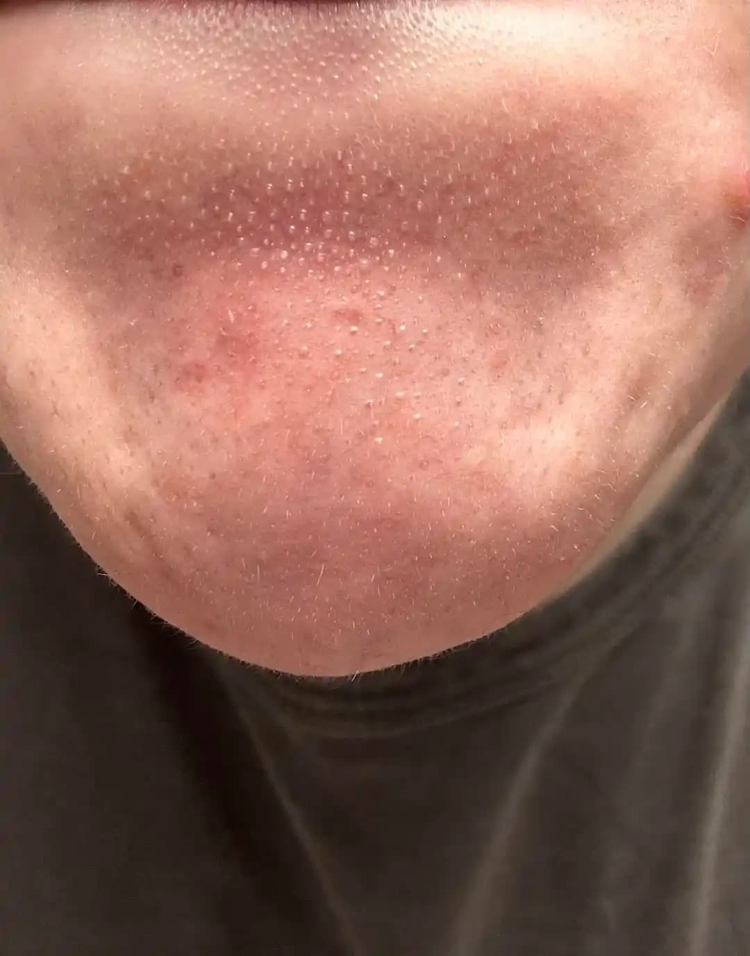 Sebase Filamentler: Doğası, Görünürlüğü ve Etkili Yönetim Yöntemleri