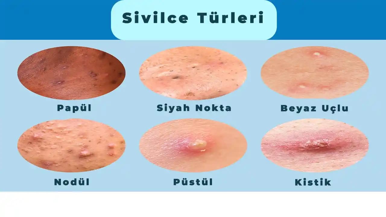 Acılı Sivilcelerin Nedenleri ve Cilt Sağlığını Koruma Yöntemleri Hakkında Detaylı Bilgi