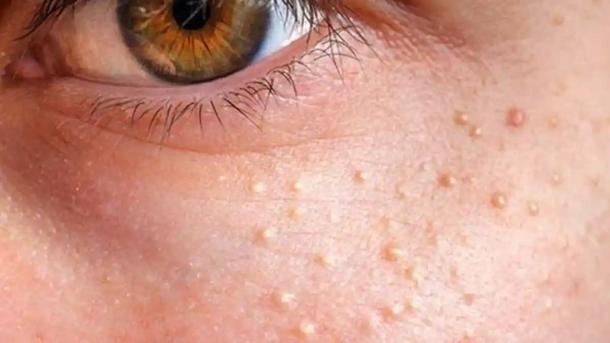 Alında Komedon Nedir, Nedenleri ve Etkili Temizlik Yöntemleri Hakkında Bilgi