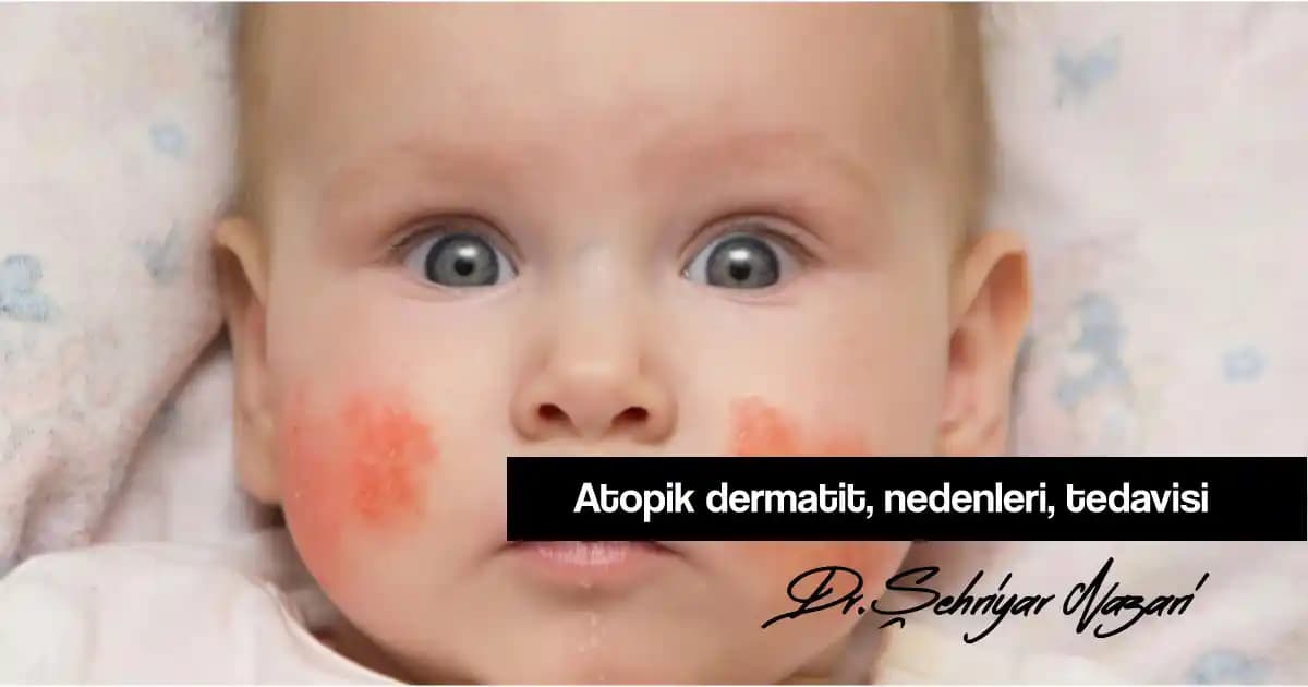 Bebeklerde Atopik Dermatit ve Kozmetik Seçenekleri: Uygun Bakım ve Ürünler