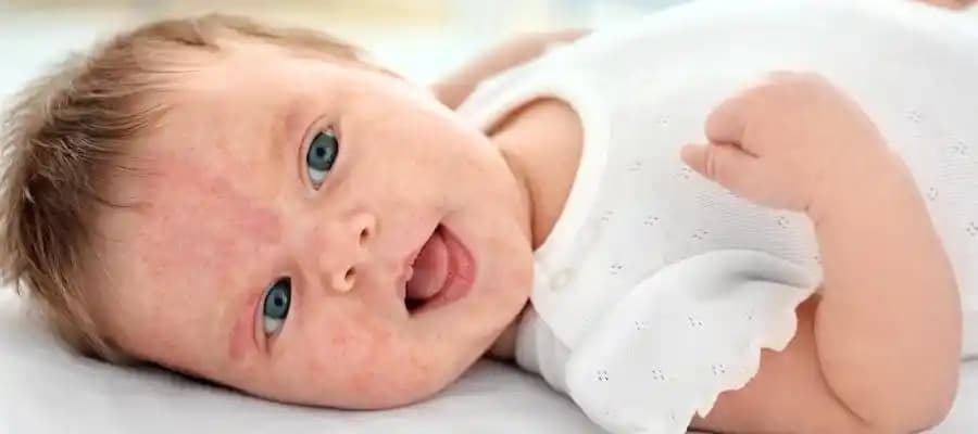 Bebeklerde Yüz Egzaması: Belirtileri, Nedenleri ve Güvenli Bakım Yöntemleri