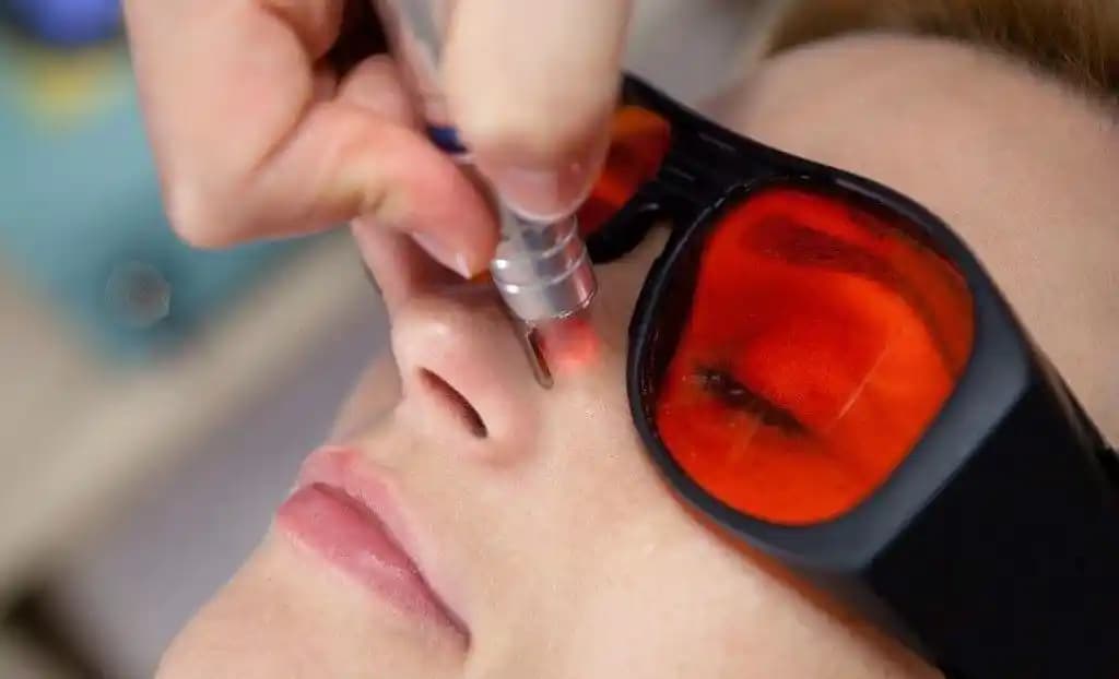 Burun Çevresindeki Kızarıklıkların Nedenleri ve Etkili Çözüm Yöntemleri