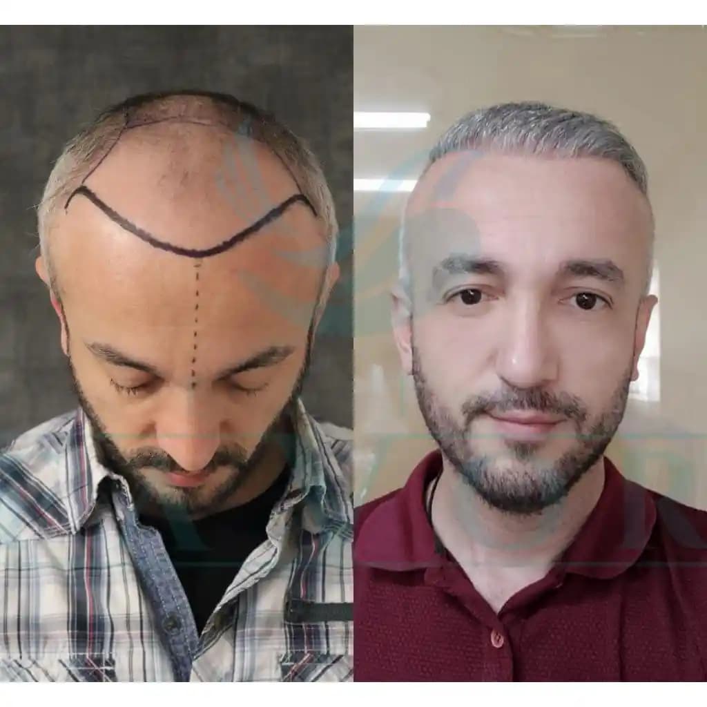 Diyarbakır'da Güvenilir ve Kaliteli Saç Ekimi Merkezleri Nasıl Seçilir