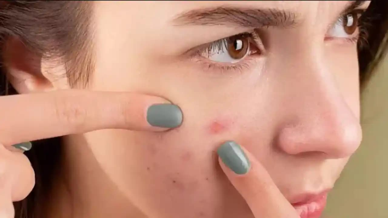 Geçmeyen Sivilceler: Nedenleri ve Uzun Süre Geçmeyen Sivilcelere Çözüm Yolları