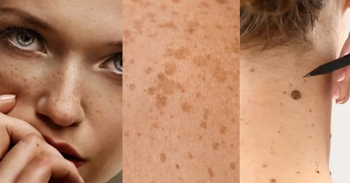 Güneş Lekeleri Nedenleri, Korunma Yöntemleri ve Etkili Bakım İpuçları