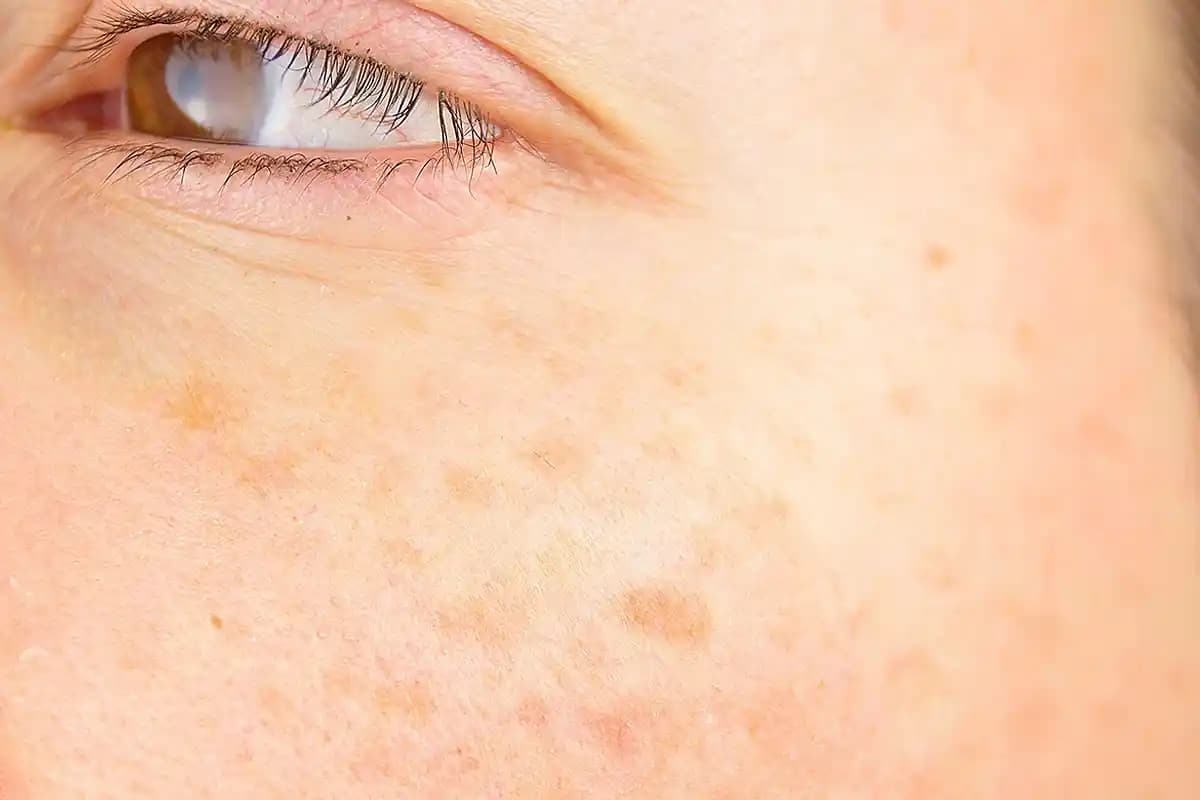 Güneş Lekeleriyle Mücadele Yöntemleri ve Cilt Koruma Rehberi