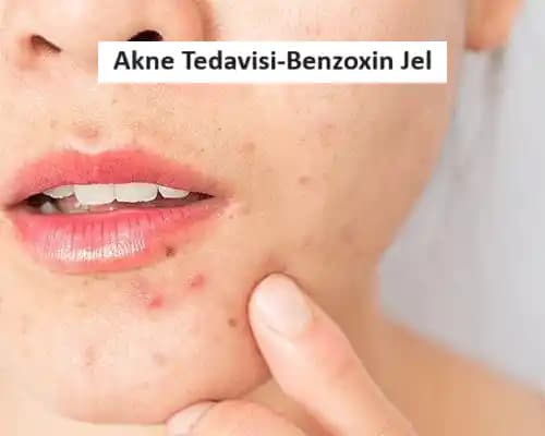 10 Yaşında Sivilce Görülür mü? Erken Dönem Cilt Sorunları ve Koruma Yöntemleri