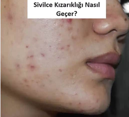 12 Yaşında Sivilce Nasıl Geçer: Ergenlikte Akneyle Başa Çıkma Yöntemleri