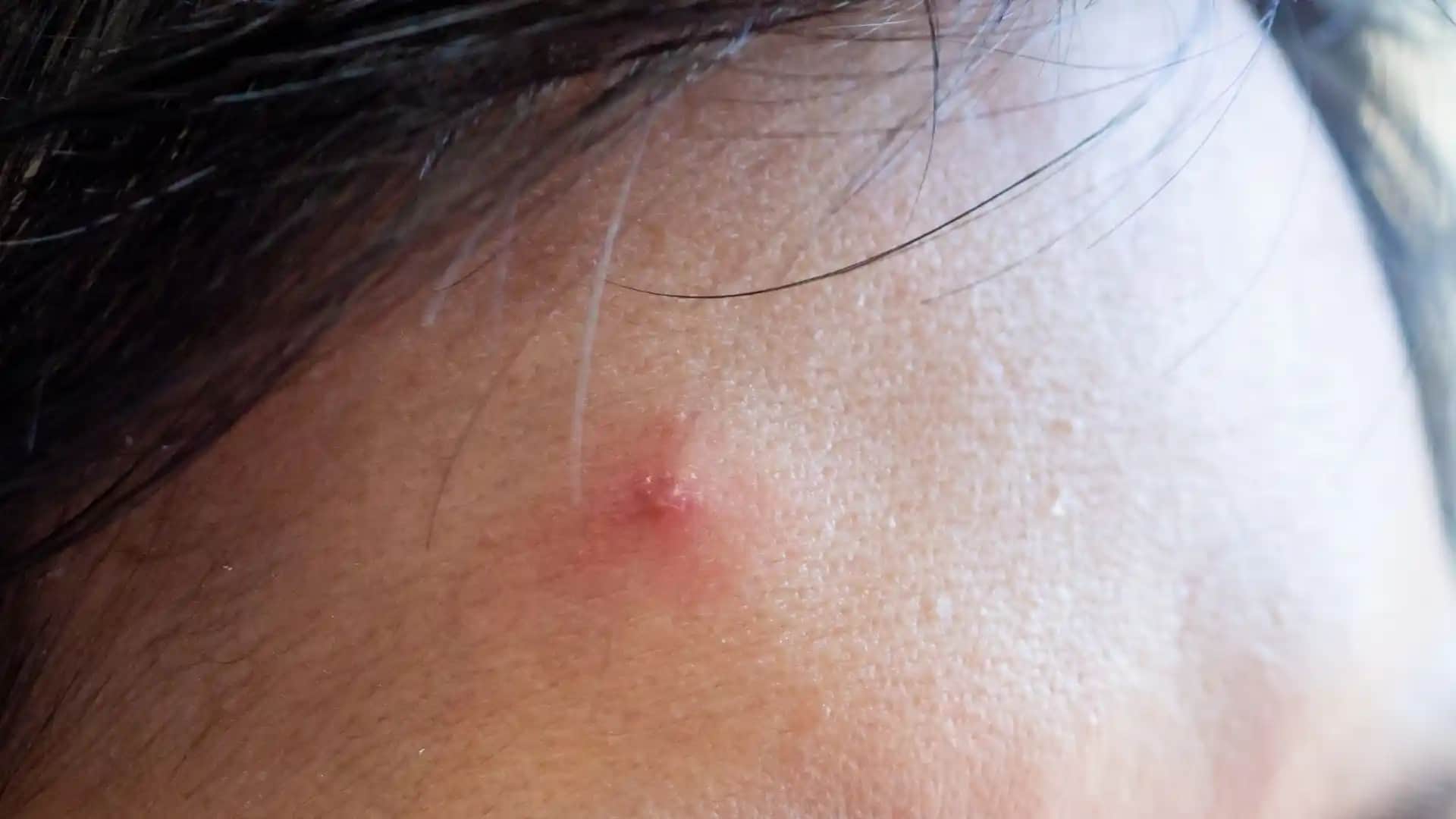 14 Yaşında Sivilceyle Mücadele Yöntemleri ve Cilt Bakımı İpuçları