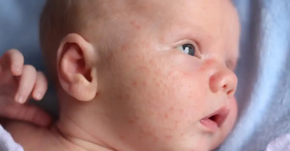 20 Günlük Bebeklerde Yüz Sivilceleri Nedenleri ve Doğal Bakım Yöntemleri