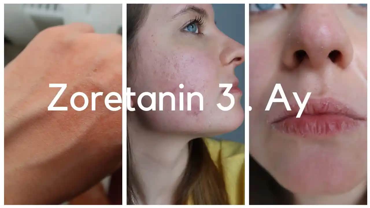 3 Yaş Sivilcesi Nedenleri ve Çocuk Cilt Sağlığı İçin Öneriler