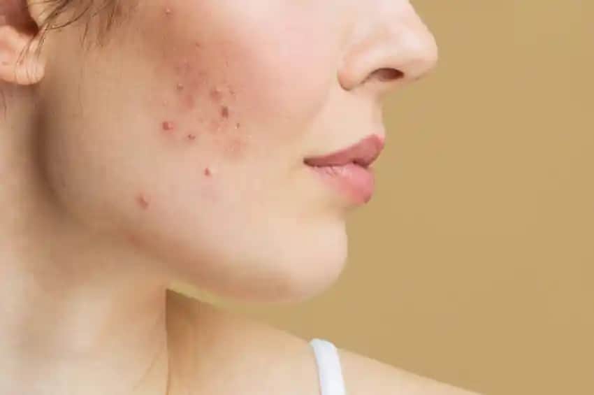 4 Aydır Geçmeyen Sivilce Sorunu ve Etkili Çözüm Yolları