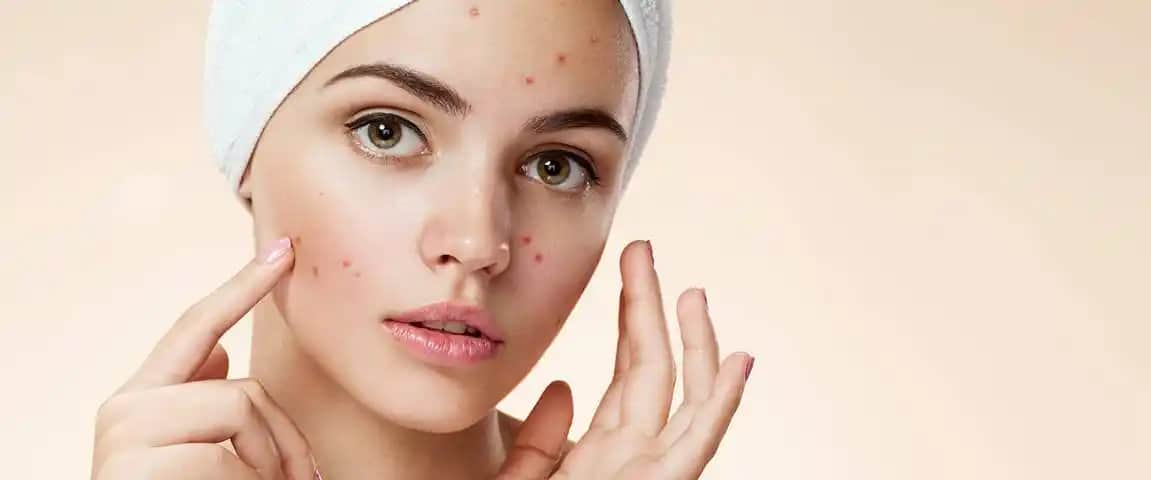 40'lı Yaşlarda Sivilce Tedavisi: Hormonal Değişiklikler ve Etkili Çözüm Yöntemleri