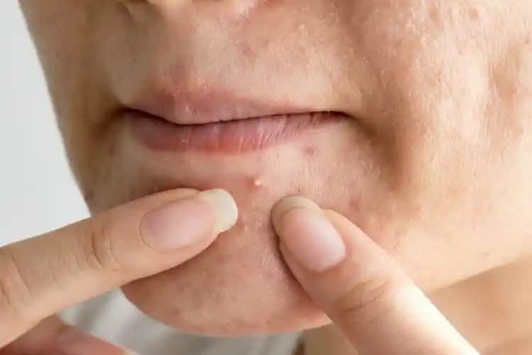 40 Yaşında Sivilce Nedenleri ve Cilt Sağlığı İpuçları