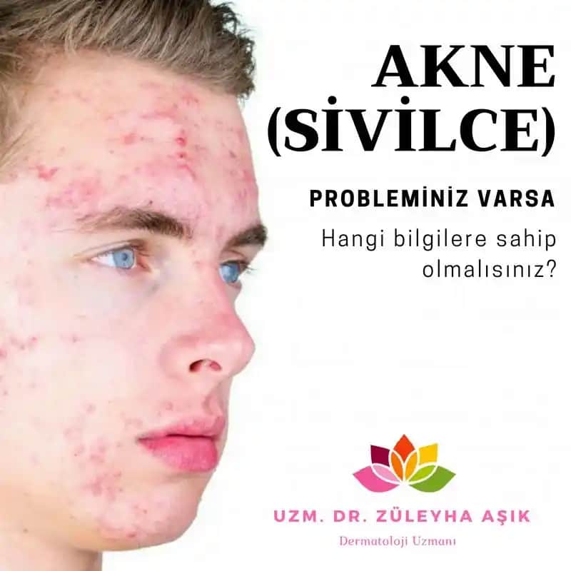 5 Yaşında Sivilce: Erken Dönemde Cilt Sağlığına Dair Bilinmesi Gerekenler ve Önlemler