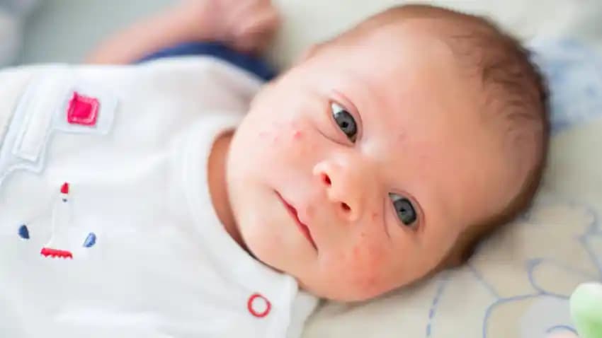 5 Yaşındaki Çocuklarda Yüz Sivilcesi Nedenleri ve Uygun Bakım Yöntemleri