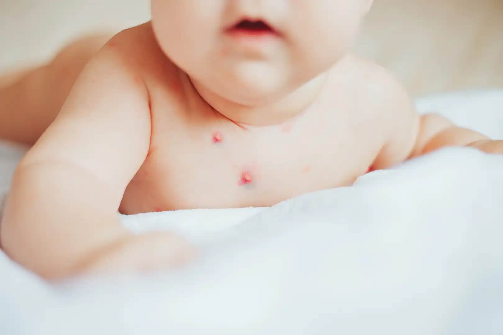 7 Yaşındaki Çocuklarda Yüzde Sivilce: Nedenleri ve Doğal Çözüm Yöntemleri