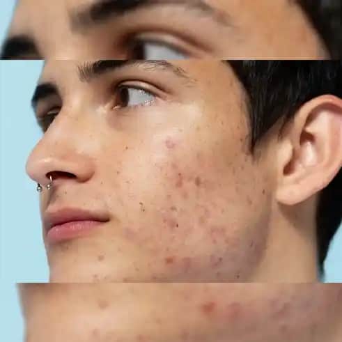 9 Yaşında Sivilce Çıkabilir mi? Çocuklarda Cilt Sağlığı ve Erken Yaşta Sivilce Nedenleri