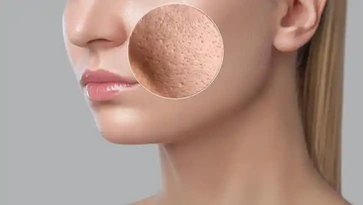 Açık Gözenekler İçin Nedenler, Bakım Yöntemleri ve Etkili Çözüm Tavsiyeleri