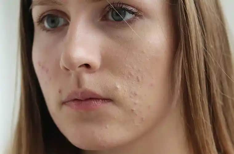 Adet Döneminde Çenede Sivilce: Hormonal Dengenin ve Cilt Sağlığının İpuçları