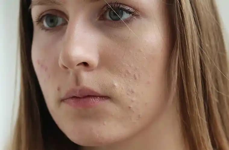 Adet Döneminde Çenede Sivilce: Hormonal Dengenin ve Cilt Sağlığının İpuçları