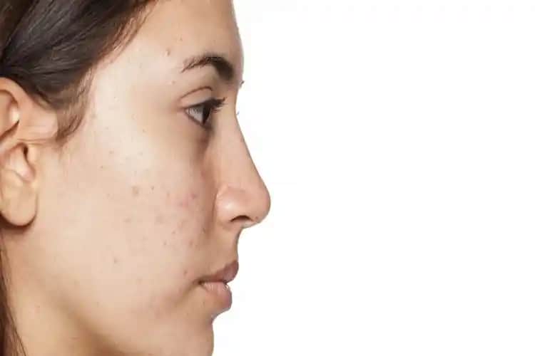 Adet Döneminde Sivilce Problemi ve Çözüm Yolları Cilt Sağlığını Korumak İçin Bilinmesi Gerekenler