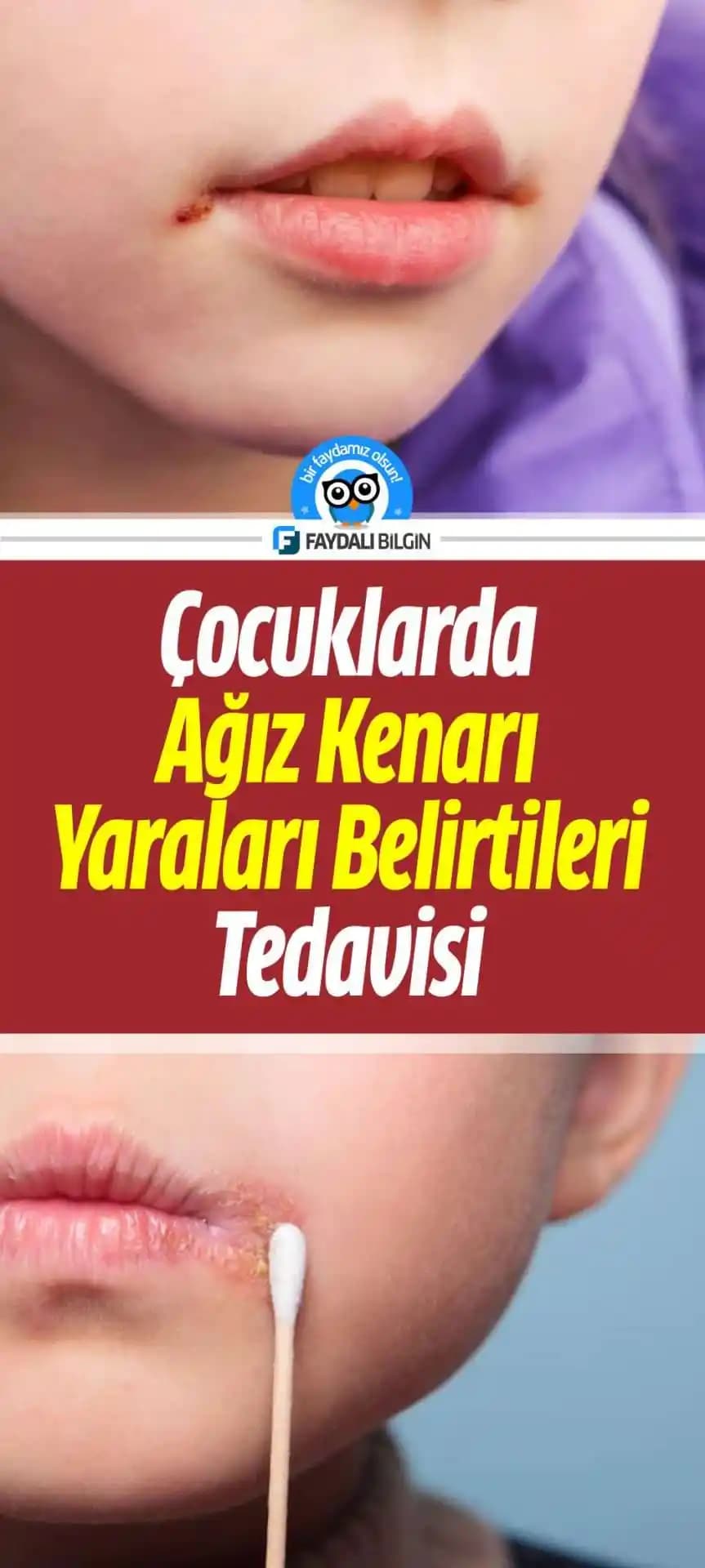 Ağız Kenarı Kararmalarının Nedenleri ve Etkili Önleme Yöntemleri