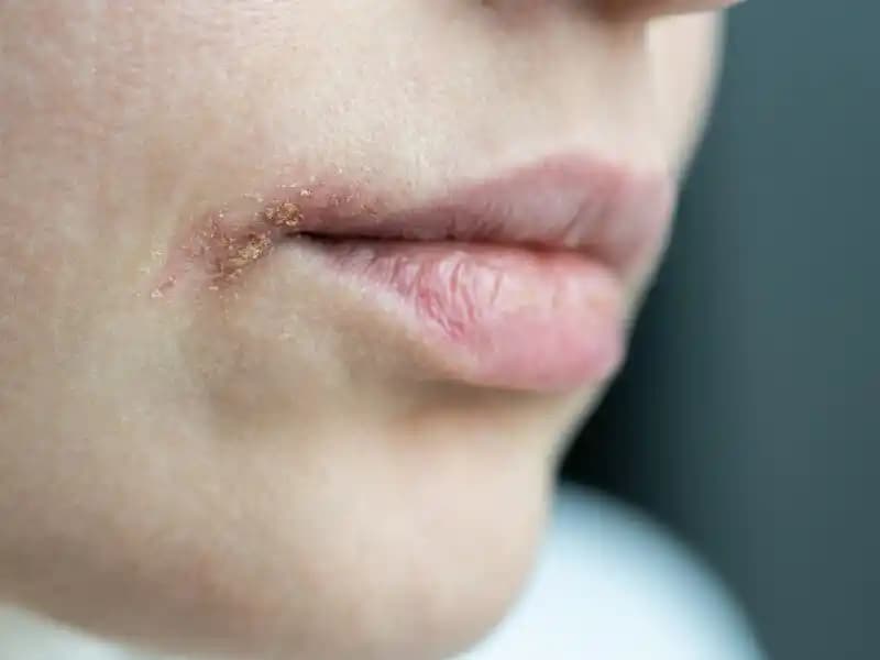 Ağız Kenarında Kuruluk ve Kızarıklık Sorunlarına Kozmetik Yaklaşımlar ve Çözüm Yöntemleri