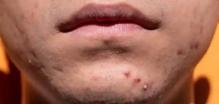 Akne Belirtileri, Nedenleri ve Uygun Bakım Yöntemleri Hakkında Detaylı Bilgi